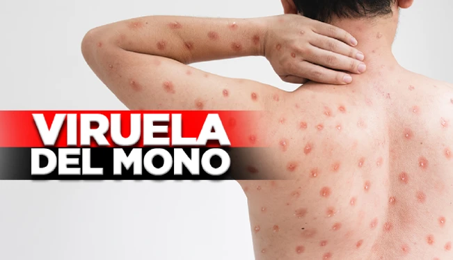 Minsal registra dos nuevos contagios de viruela del mono en El Salvador