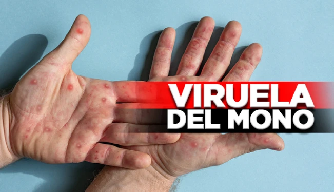Reportan dos nuevos casos de viruela del mono y suben a nueve los contagiados en El Salvador