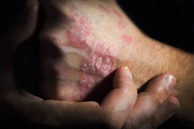 La psoriasis, una enfermedad sin cura que no solo afecta la piel