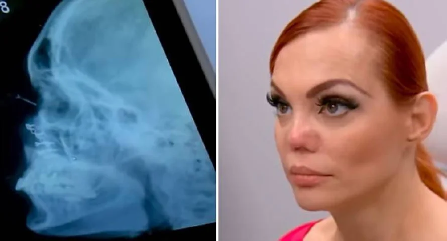 E! revela la desgarradora verdad sobre la nariz de la modelo Carmen Campuzano