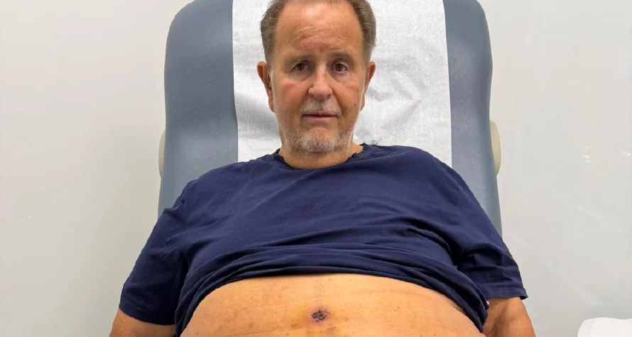 Raúl De Molina sufre complicaciones tras una cirugía para retirar piel de su abdomen