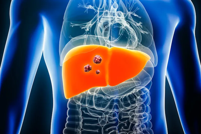 Diagnósticos de cáncer de hígado se duplicarán para 2050, advierte The Lancet
