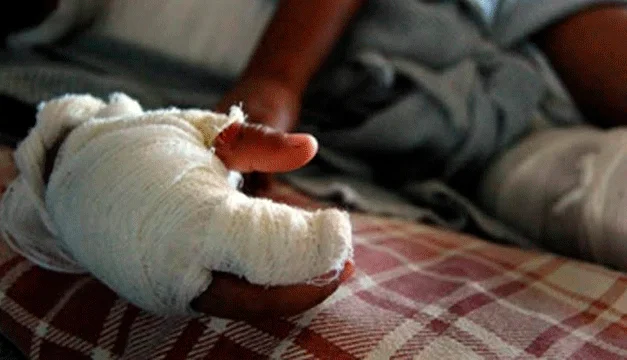 La exposición a líquidos calientes es la principal causa de menores quemados en El Salvador