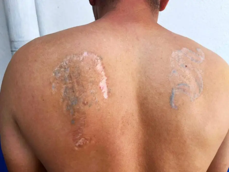 Detienen a miembro de la MS-13 que intentó borrar sus tatuajes