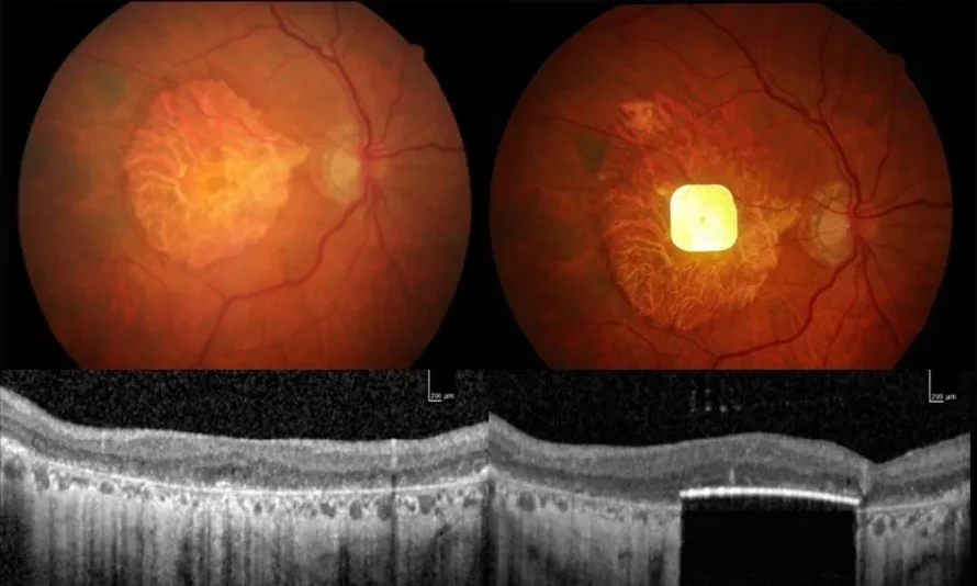 Nueva prótesis ocular permite leer a personas con ceguera irreversible