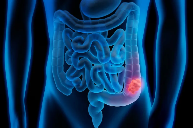 Vacuna experimental muestra eficacia en prevenir cáncer en pacientes con síndrome de Lynch