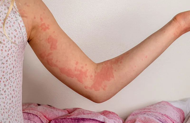 Las alergias alimentarias en la infancia las causan una combinación de factores genéticos, ambientales y microbianos