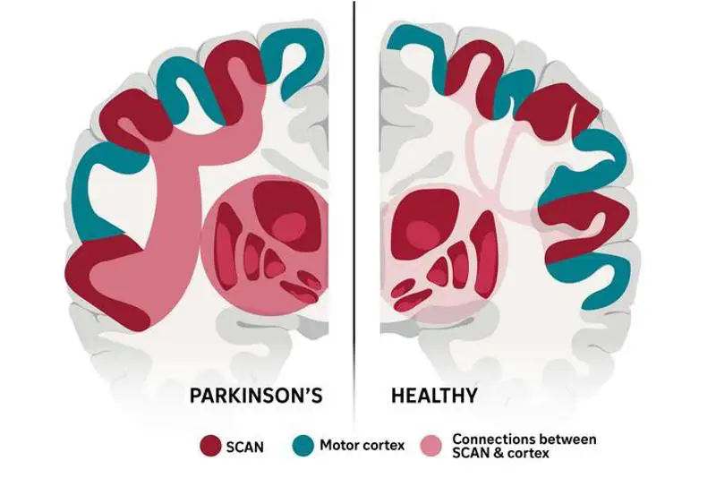 Estimulación cerebral precisa mejora los síntomas del párkinson, revela estudio