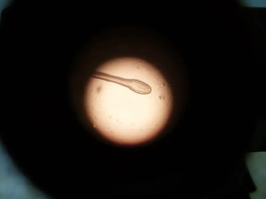 Detectan transmisión genética rara por donante de esperma