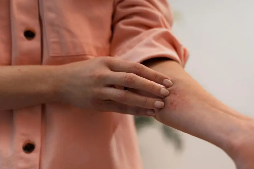 El cuidado de la dermatitis atópica exige constancia en la piel aun en ausencia de síntomas
